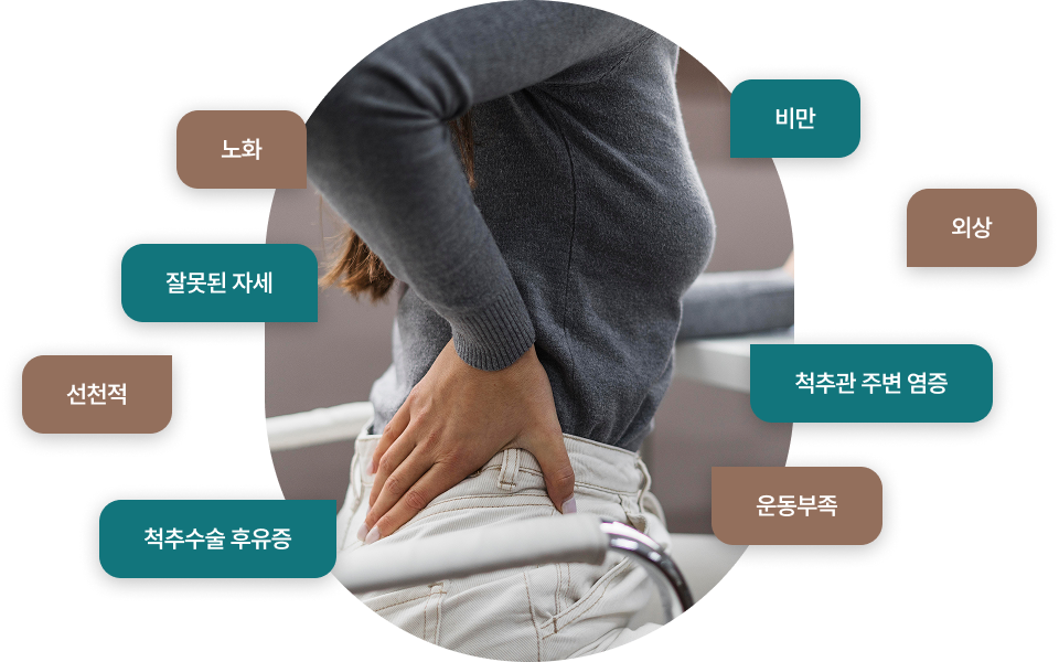 척추관협착증의 원인