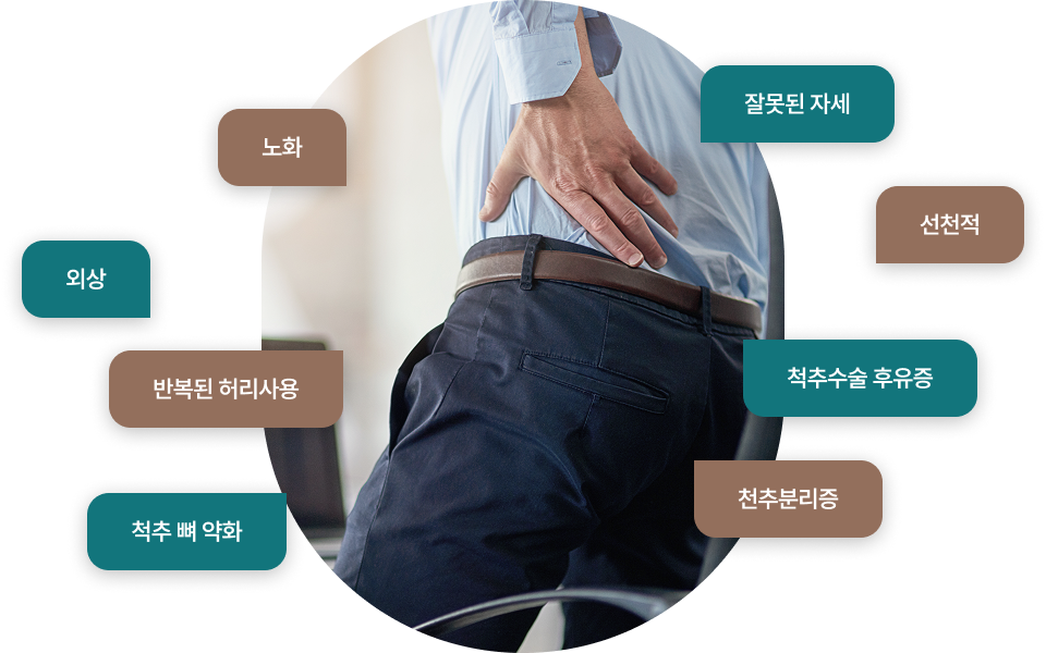 전방전위증의 원인