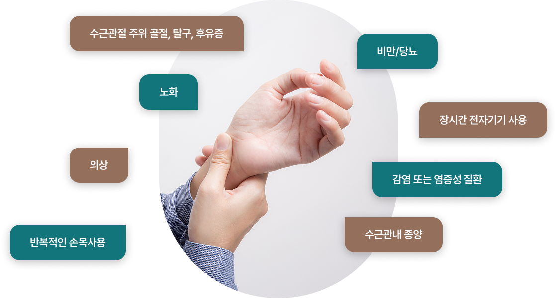 손목터널증후군의 원인